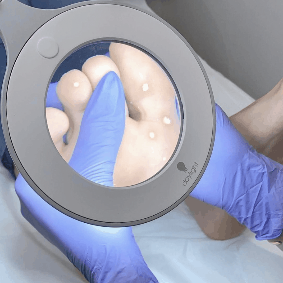 Foot with verrus being lit with a professional daylight lamp