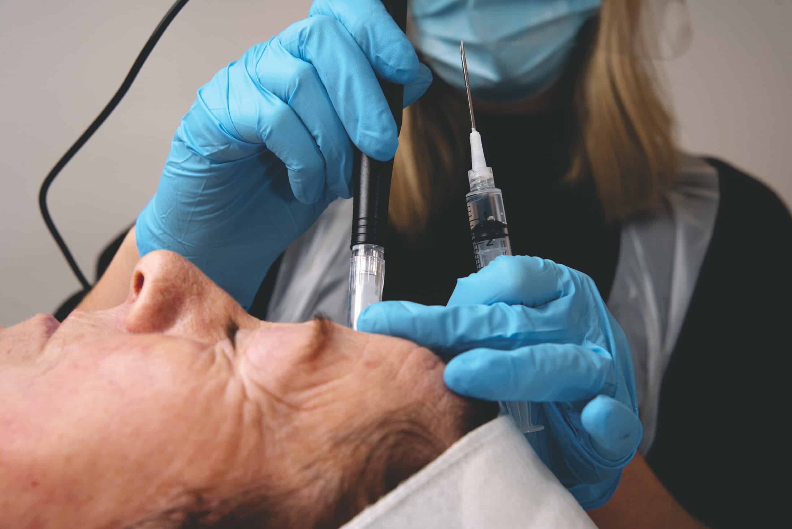  fractional miso therapy using miso fusion for aging