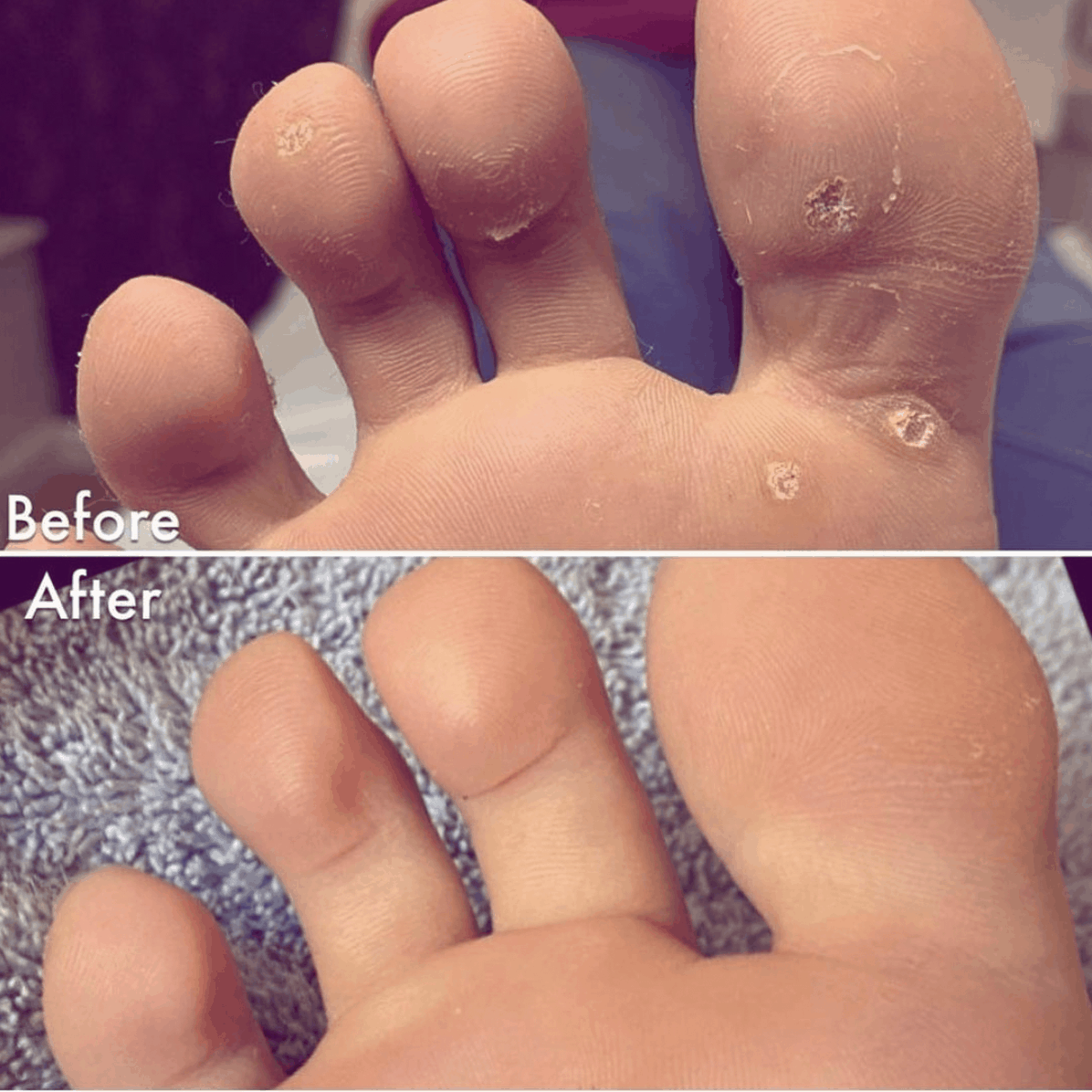Verruca Before and after treatment using advanced electrolysis technique t 