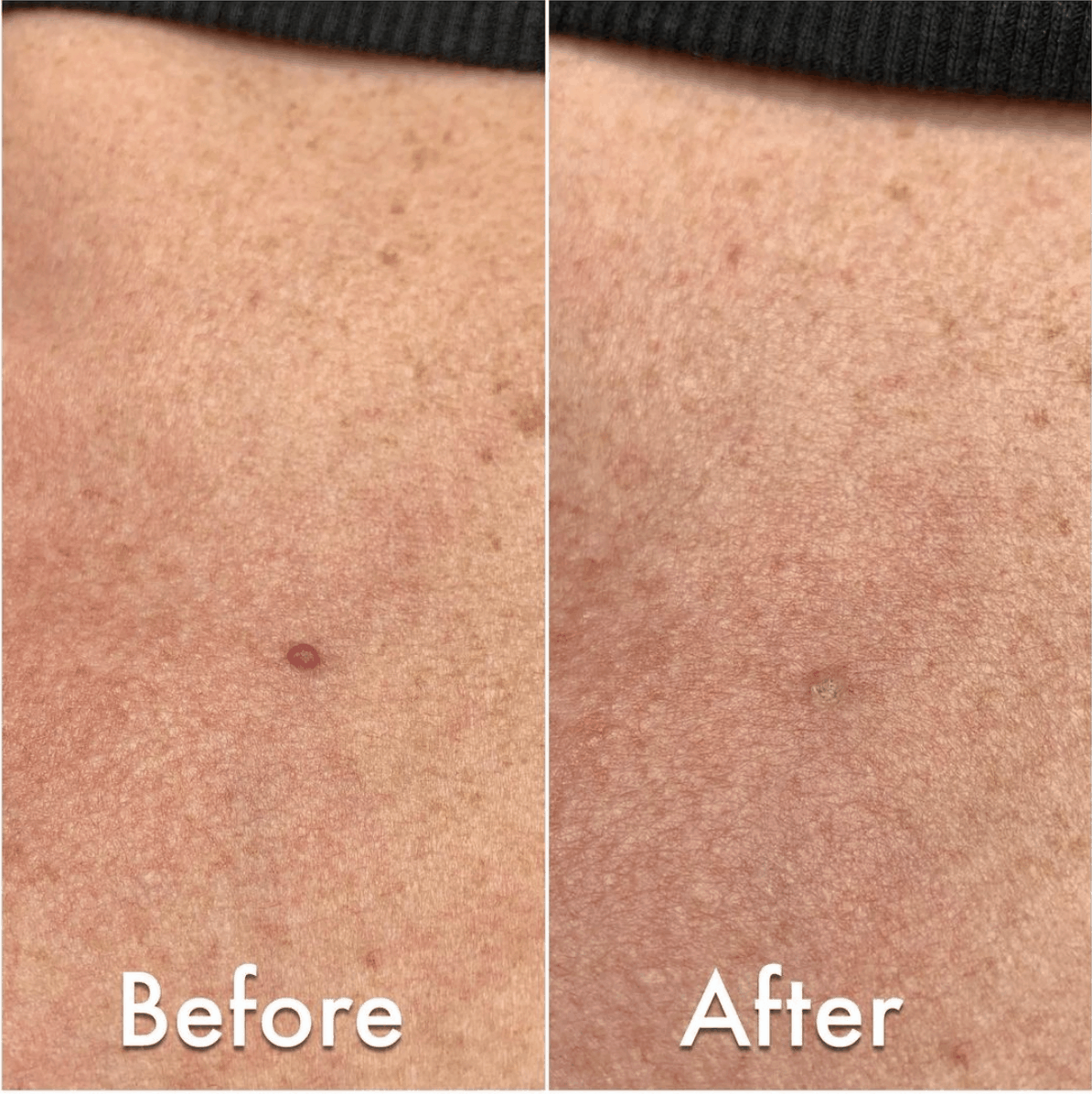 Cambell de morgan spot on skin before and after treatement showing the blood spot gone