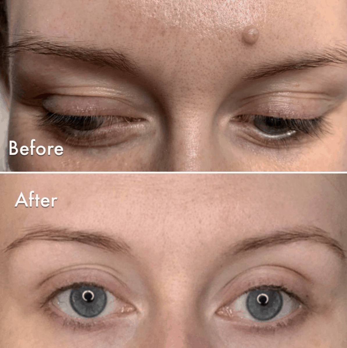 Mole reduction using an advanced electrolysis on a ladies face mole between eyebrows