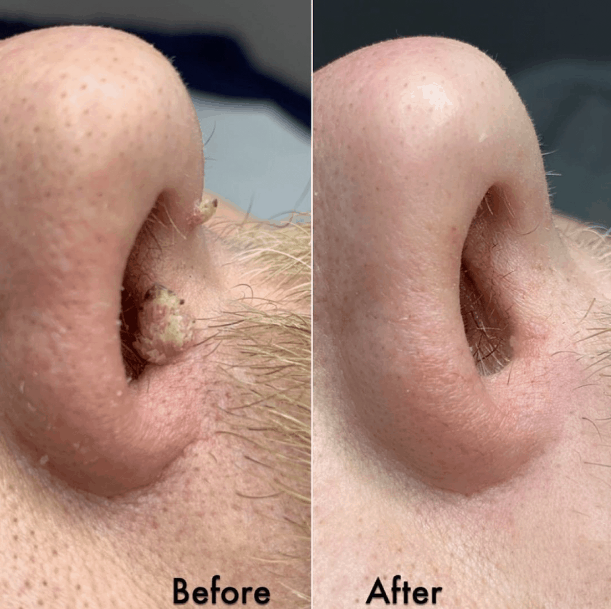 Wart on nose showing before and after treatment photo