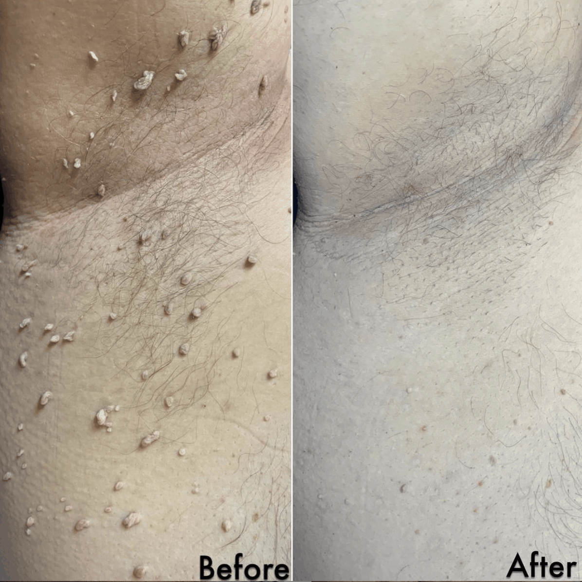 Ander arm showing multiple skintags before and after treatment to remove them using ana advanced electrolysis technique
