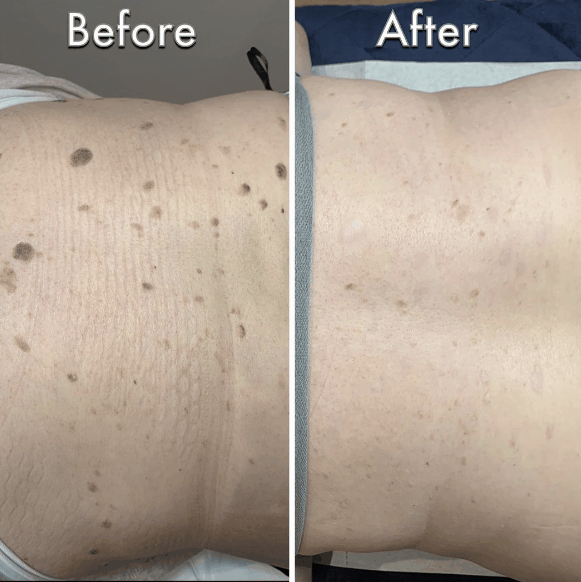 Sebhorric keratosis image before and after treatment on back using advanced electrolysis