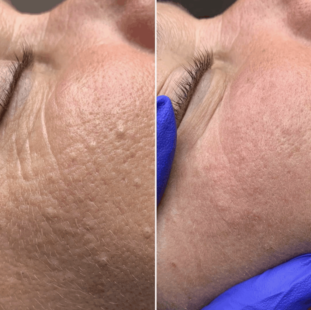 Milia on face before and after treatment