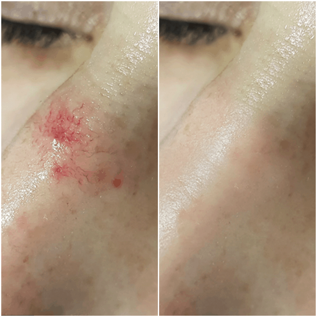 Spider vevi before an advanced electrolysis treatement showing the blood spot gone